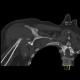 Extraction of head of humerus: CT - Computed tomography